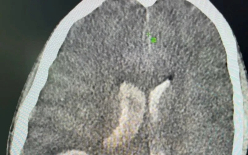 Bé trai được xác định xuất huyết não qua hình ảnh cắt lớp vi tính. Ảnh: Thời báo VTV