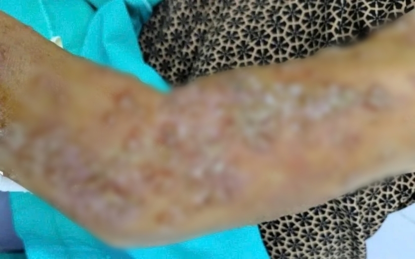 Vùng cánh tay phải của bệnh nhân bị sưng tấy, đau rát, viêm đỏ, nổi mụn nước và có một vài ổ loét. Ảnh: Thời báo VTV