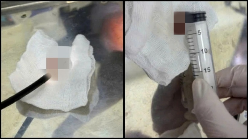 Dị vật được đưa ra ngoài. Ảnh: Giáo dục & Thời đại