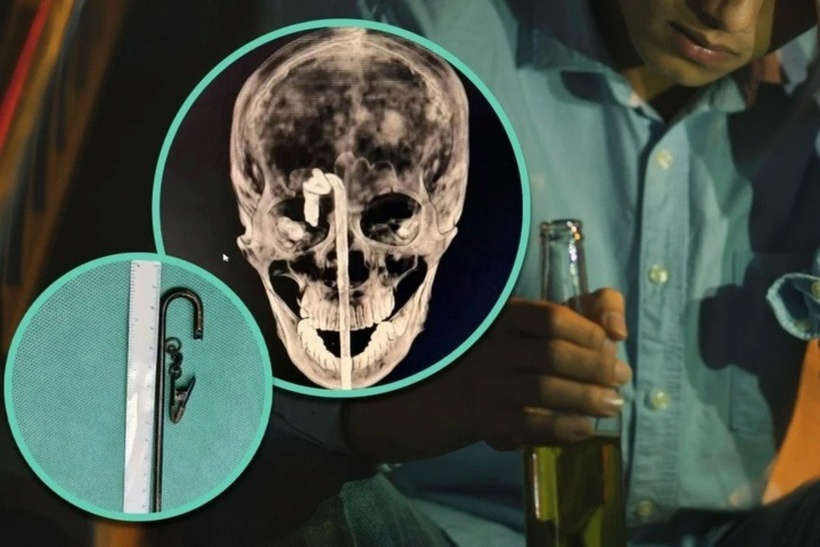 Thanh sắt đâm trúng nam thanh niên. Ảnh: SCMP.