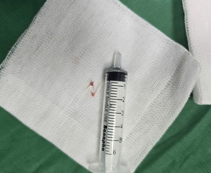 Dị vật xương cá được các bác sĩ gắp ra từ đường thở của trẻ. Ảnh: BVCC.
