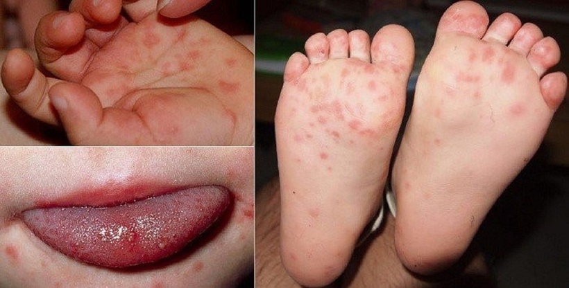 Bệnh tay chân miệng đặc trưng bởi các phát ban dạng phỏng nước ở lòng bàn tay, bàn chân và miệng.