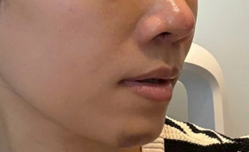 Việc thực hiện chỉnh sửa mũi tại các cơ sở không uy tín, tay nghề bác sĩ kém, chất liệu không đảm bảo có thể khiến người bệnh gặp phải biến chứng. Ảnh minh họa.