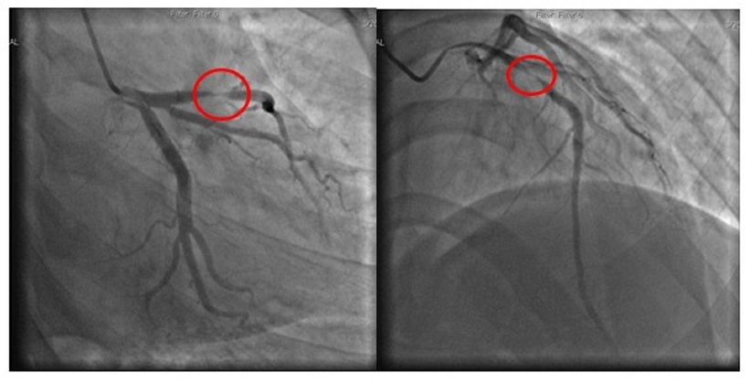 Hình ảnh phim chụp thể hiện động mạch bị tắc. Ảnh: BVCC