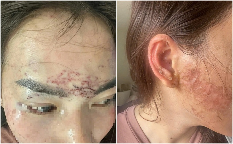 Những vết thương trên trán, má phải của chị P.H.M. (Ảnh: Thanh niên)