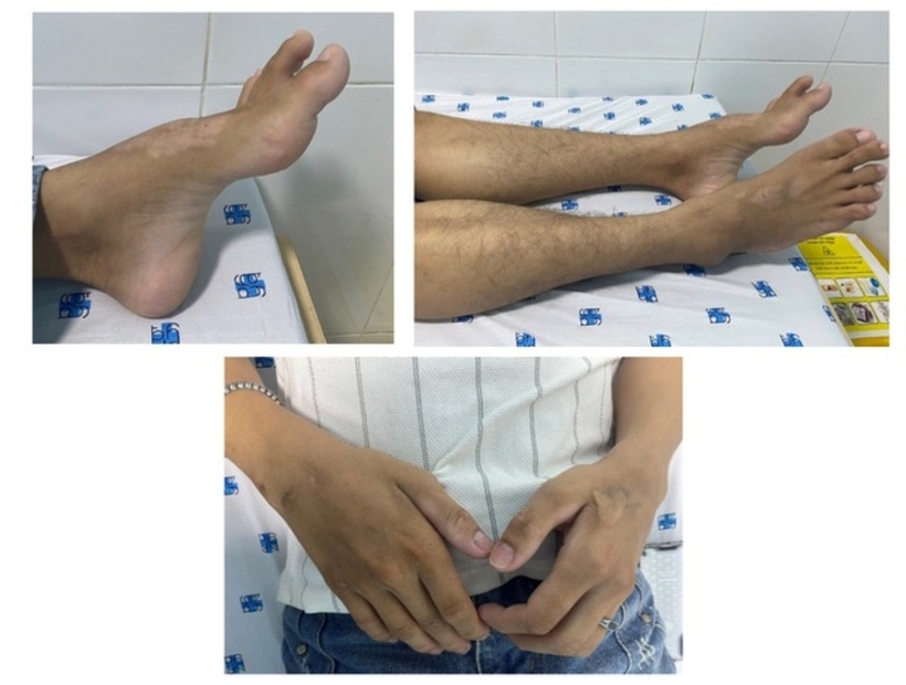 Bệnh nhận mắc bệnh Charcot-Marie-Tooth (CMT) – một bệnh lý thần kinh di truyền mạn tính. Ảnh: Người Lao Động