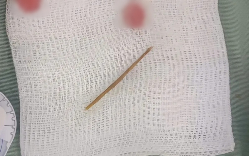 Dị vật là một chiếc tăm tre nhọn dài khoảng 4cm. Ảnh: Thời báo VTV
