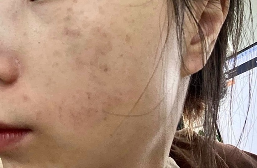 Từ khao khát có được làn da căng bóng, trẻ trung, cô gái trẻ đã tìm đến phương pháp tiêm filler tưởng chừng như "vị cứu tinh"...Ảnh: VnExpress