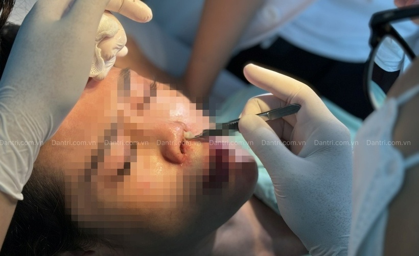 Chiếc mũi chảy dịch. Ảnh: Dân Trí.