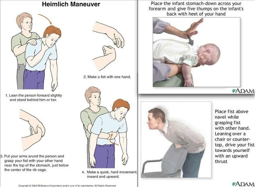 Nghiệm pháp Heimlich. Ảnh: BVCC.