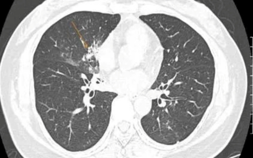Hình ảnh chụp cắt lớp vi tính cho thấy đám đông đặc kèm kính mờ ở phổi. Ảnh: Thời báo VTV