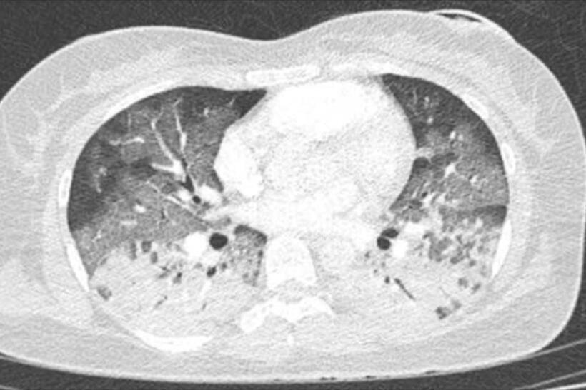 Khi chuyển đến Bệnh viện Nhân dân Gia Định phổi cô gái bị tổn thương đông đặc. Ảnh: Dân Trí.