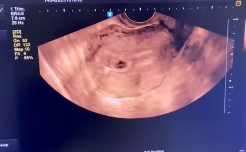 Hình ảnh siêu âm thai của chị B.T.T. Ảnh: Sở Y tế Phú Thọ.