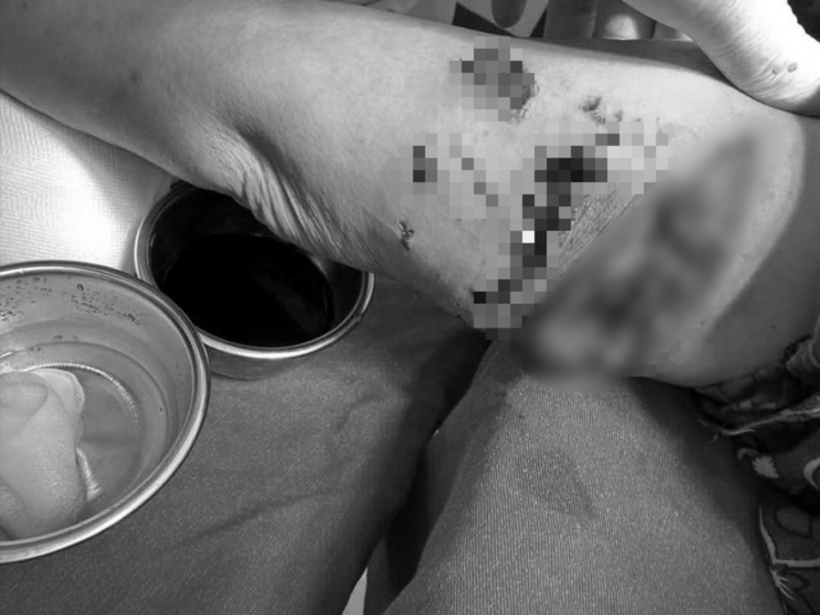 Cụ bà được đưa đến Trung tâm Y tế huyện Lục Yên trong tình trạng nhiều vết thương lớn nhỏ khắp người. Ảnh: Sức Khỏe & Đời Sống