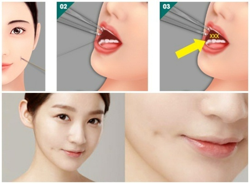 Để ngăn ngừa nguy cơ nhiễm trùng, phẫu thuật tạo má lúm đồng tiền đòi hỏi việc tuân thủ chặt chẽ các quy trình y tế. Ảnh minh họa.