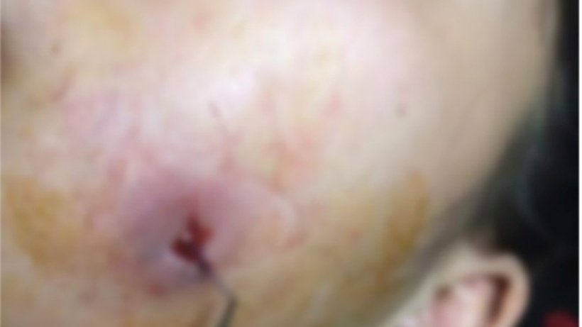 Phẫu thuật má lúm đồng tiền tiềm ẩn nhiều rủi ro. Ảnh: Tiền Phong.