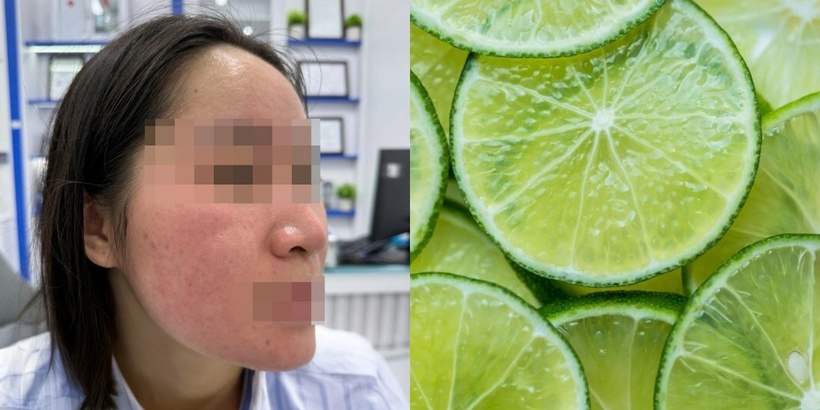 Sử dụng chanh làm đẹp khiến cô gái "hỏng mặt". Ảnh: BSCC