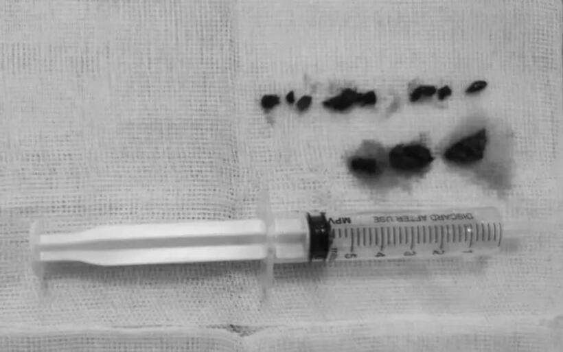 Huyết khối được lấy ra ngoài. Ảnh: Thời báo VTV