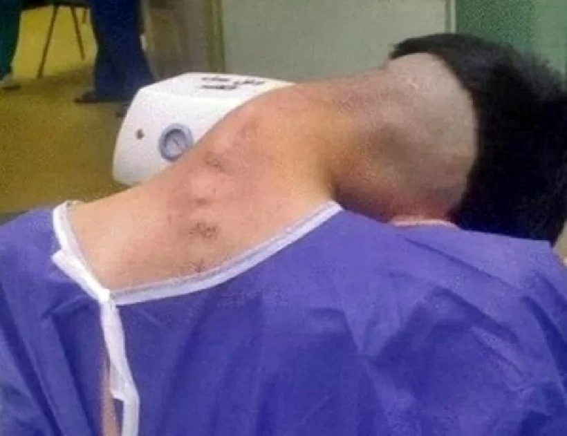 Nam thanh niên mắc “hội chứng đầu gục” sau nhiều năm lạm dụng các chất gây nghiện. Ảnh: Oddity Central.