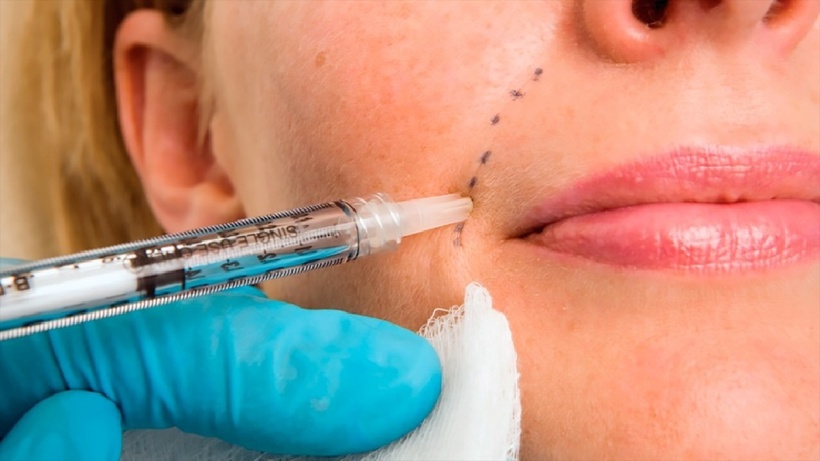 Tiêm filler (tiêm chất làm đầy da) là một trong những thủ thuật được thực hiện phổ biến nhất trong da liễu thẩm mỹ.
