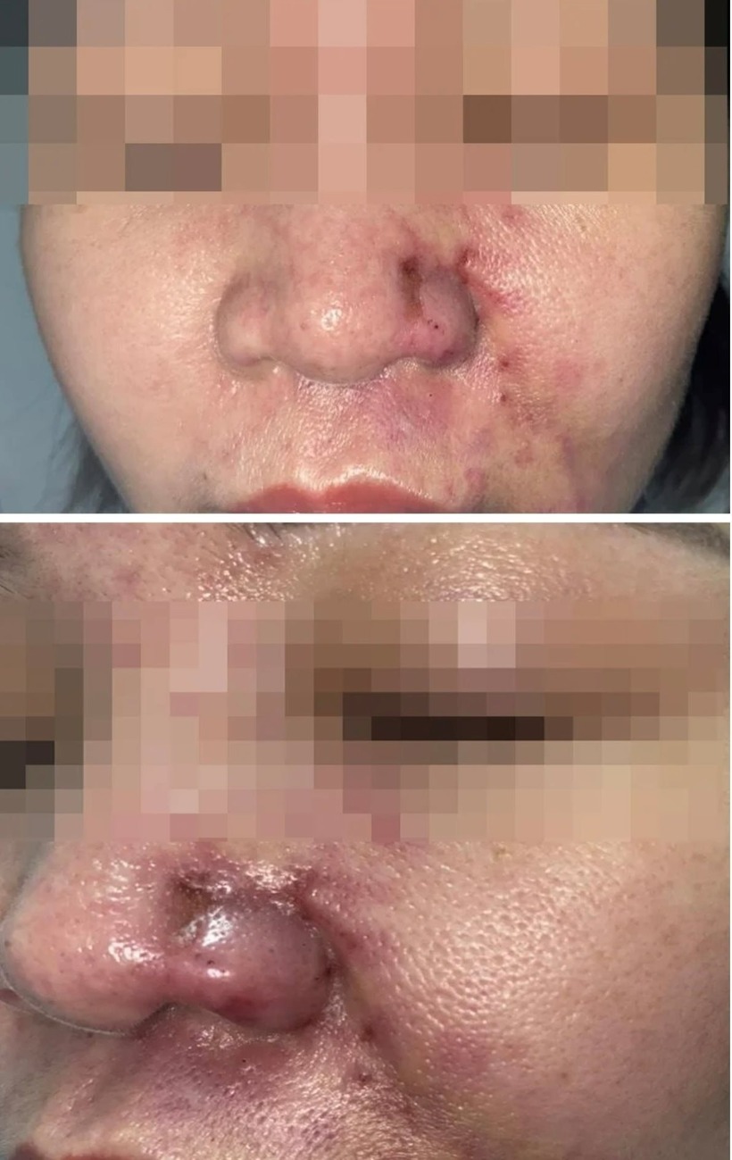 Vùng mũi bệnh nhân có biểu hiện tụ máu, sưng nề và đau nhức.