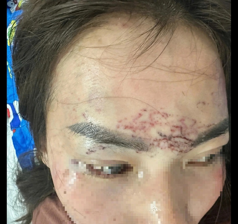 Bùng trán chị M. có nhiều vết sưng đỏ, trầy xước, má và tay phải bị tổn thương. Ảnh: Báo Thanh niên.