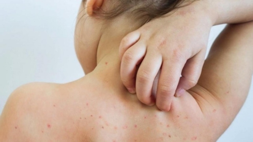 Bất cứ ai cũng có thể nhiễm rubella, đặc biệt là những người chưa được tiêm vaccine phòng bệnh. Ảnh minh họa