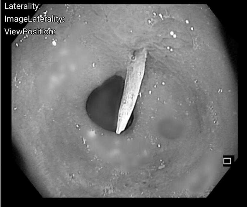 Hình ảnh dị vật dài khoảng 4cm, nghi là xương cá, đâm xuyên qua thành sau dạ dày vào trong ổ bụng. Ảnh: Sức Khỏe & Đời Sống