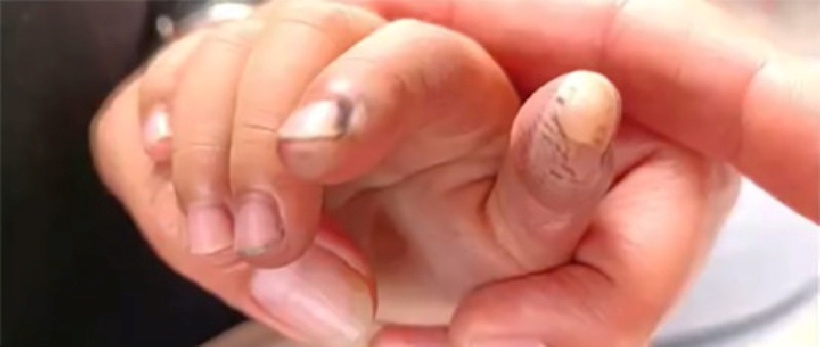 Một ngón tay của bé trai bị bỏng do điện giật. Ảnh: Sohu.