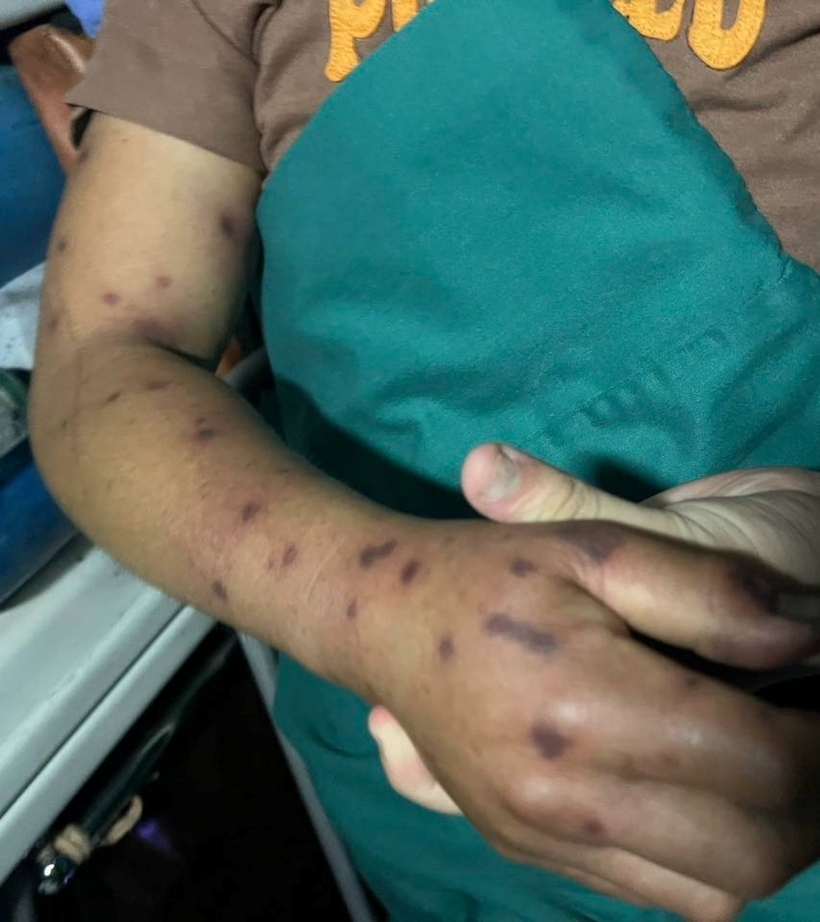 Trên người bệnh nhân có hơn 150 vết ong đốt chi chít, đỏ sẫm, phồng rộp gây đau nhức dữ dội. Ảnh: VietNamNet