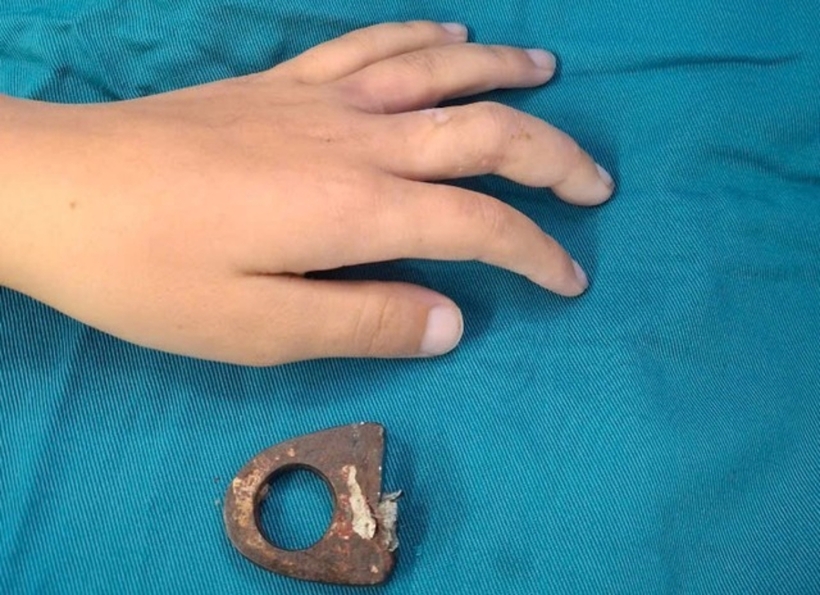 Vòng khóa cửa được tháo ra khỏi tay bệnh nhi. Ảnh: Sức Khỏe & Đời Sống