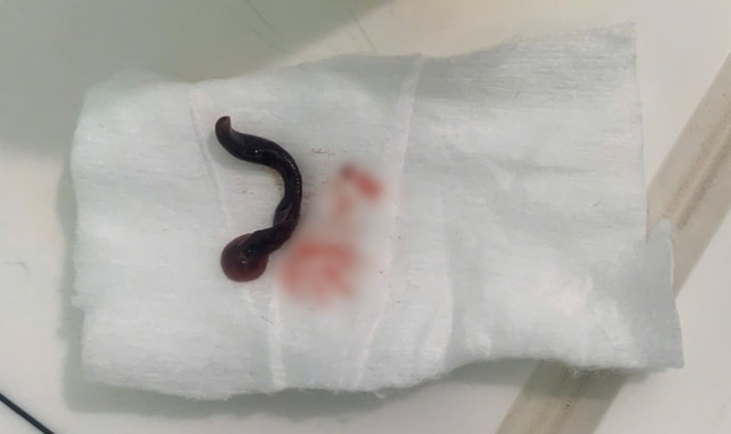 Con vắt dài khoản 4cm được gắp ra ngoài. Ảnh: Sức Khỏe & Đời Sống