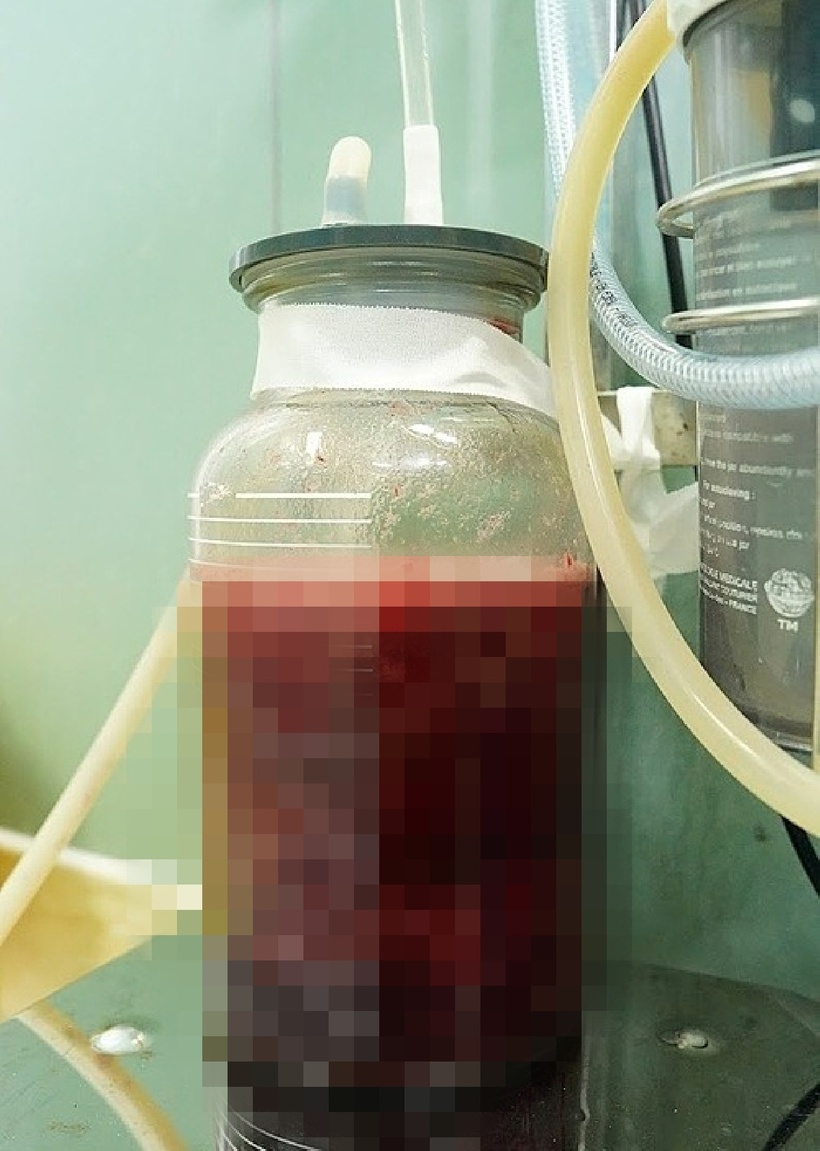 Sau ba giờ phẫu thuật, ê kíp hút gần một lít gồm filler, dịch mủ, mô hoại tử và nhiều tạp chất không xác định. Ảnh: VnExpress.