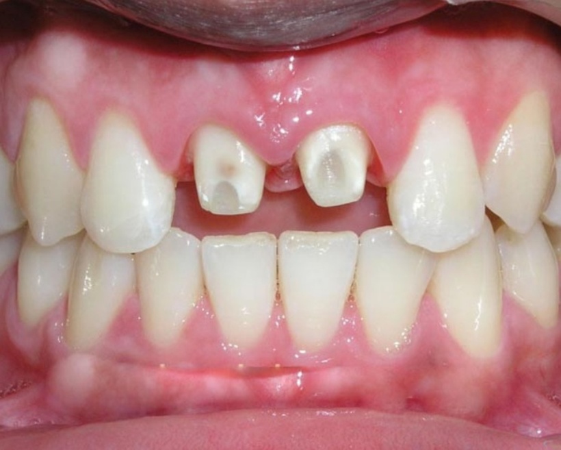 Sai lầm nghiêm trọng của nhiều người là chỉ quan tâm đến giá cả mà không quan tâm đến xuất xứ, chủng loại của răng sứ. Ảnh minh họa.