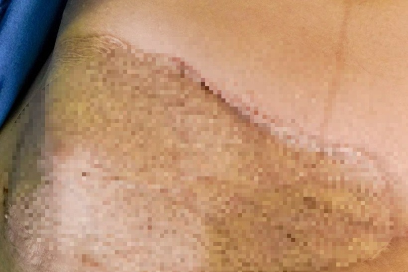 Trên cơ thể chị N chi chít những vết sẹo chằng chịt, lồi lõm. Ảnh: Báo Dân trí.