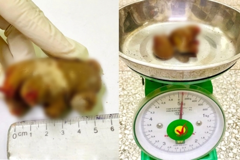 Viên sỏi thận kích thước "khủng" được lấy ra thành công. Ảnh: Pháp Luật & Xã Hội