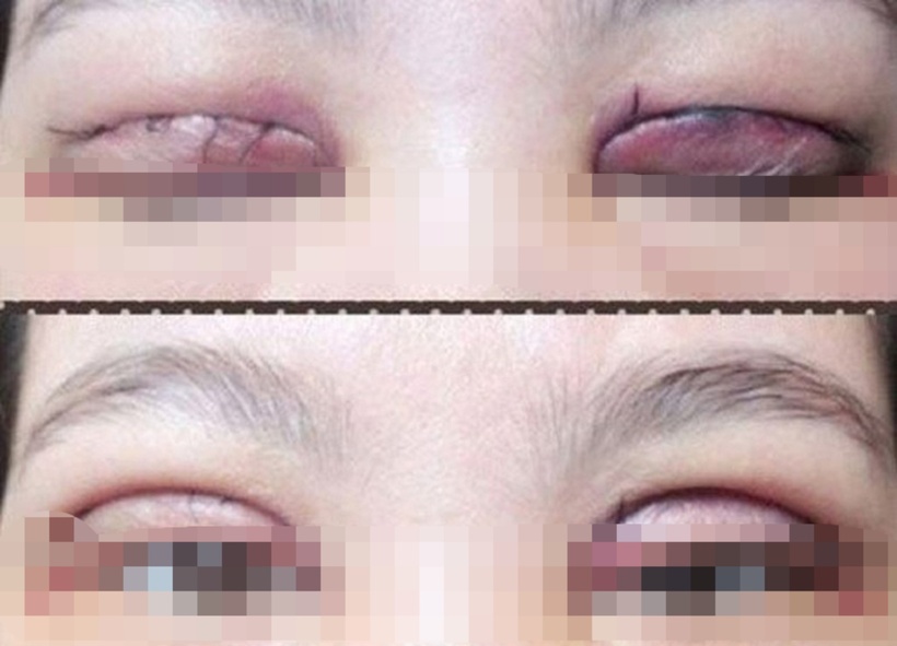 Các triệu chứng của nhiễm khuẩn do cắt mí có thể bao gồm đau, đỏ, sưng và ứ đọng mủ ở vùng khe mí. Ảnh minh họa.