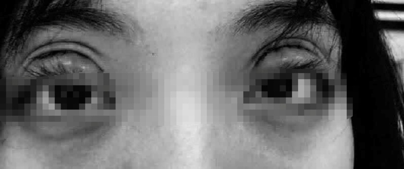 Việc thực hiện các phẫu thuật vùng mắt như cắt mí, lấy mỡ... tại spa không có giấy phép hoặc bởi người không có chuyên môn đang dẫn đến nhiều biến chứng nguy hiểm. Ảnh minh họa.