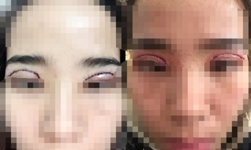 Với trường hợp phẫu thuật cắt mí lỗi, hỏng, thông thường bệnh nhân cần đợi từ 3 đến 6 tháng để thực hiện cuộc phẫu thuật tiếp theo. Ảnh minh họa.