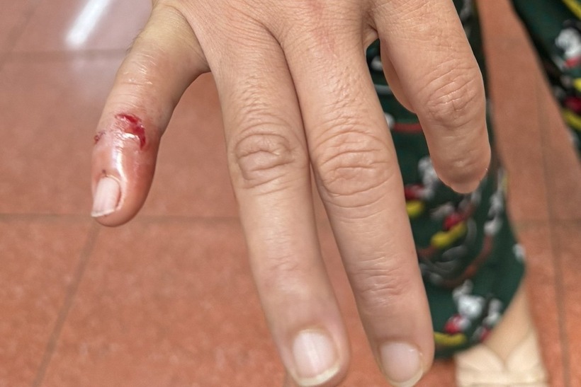 Một trong những nạn nhân bị chó dại tấn công. Ảnh: VietNamNet.