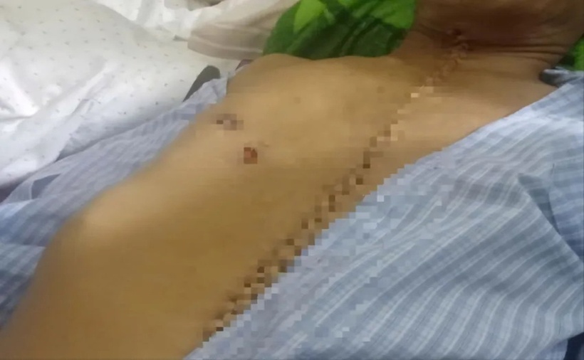Vết thương của ông M bị Nga bắn trọng thương dẫn đến tử vong. (Ảnh: Pháp luật TP.HCM)