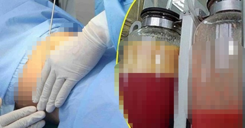 Nếu việc hút mỡ được thực hiện ở các bệnh viện lớn, nếu không may xảy ra tai biến này sẽ được cấp cứu kịp thời. Còn nếu thực hiện ở những cơ sở thẩm mỹ không đủ điều kiện cấp cứu thì có thể gây ra hậu quả khó lường. Ảnh minh họa.