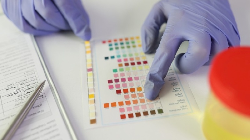 Một trong những thay đổi phổ biến nhất về nước tiểu ở bệnh nhân&nbsp;suy thận&nbsp;là màu nâu sẫm, màu trà hoặc màu cola.