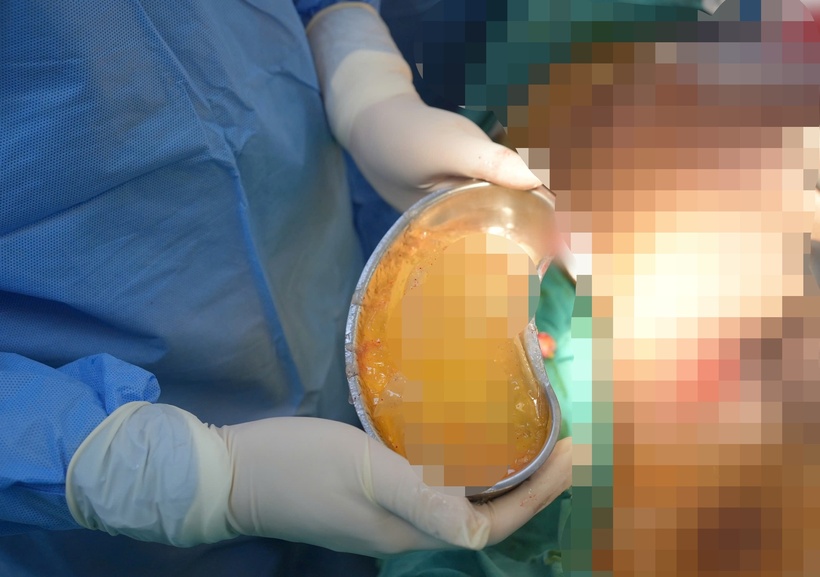 Ê kíp phẫu thuật tháo bỏ túi vỡ, bóc toàn bộ bao xơ và thay túi ngực mới cho người phụ nữ. Ảnh: Sức khỏe & Đời sống.