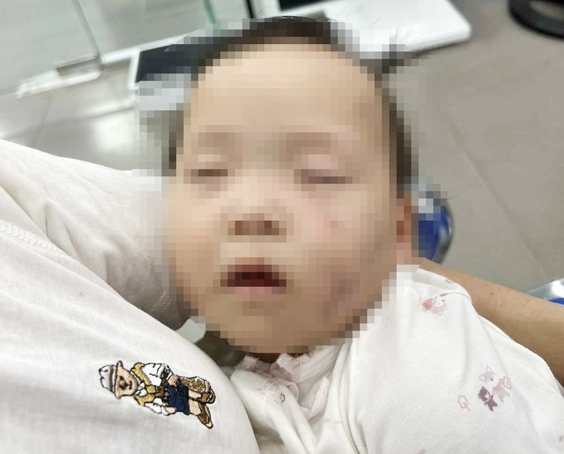 Bé gái bị bầm tím mặt khi được gửi tại cơ sở mầm non tư thục ở Bắc Ninh. Ảnh: Tiền phong
