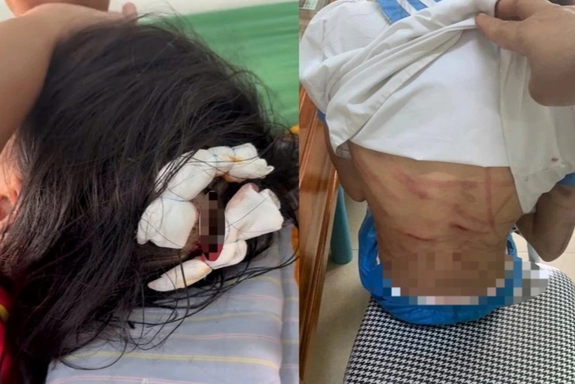 Nữ sinh bị bạo hành với nhiều vết thương ở đầu và cơ thể. Ảnh: VietNamnet