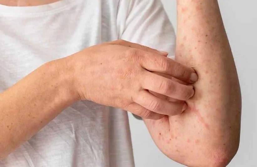 Theo các bác sĩ, nổi mề đay sau sinh tuy không gây nguy hiểm nghiêm trọng đến tính mạng nhưng lại ảnh hưởng rất lớn đến chất lượng giấc ngủ và tâm lý của người mẹ.