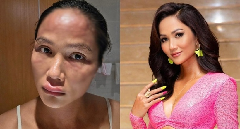 Hoa hậu H'Hen Niê chia sẻ về tình trạng bệnh lý. Ảnh: Lao động