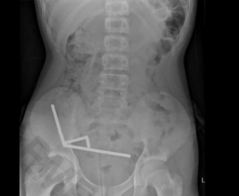 Hình ảnh chụp X-quang cho thấy các viên nam châm đã kết lại thành 4 chuỗi thẳng hàng, Ảnh: &nbsp;New Zealand Medical Journal.