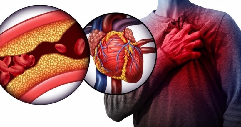 Nhồi máu cơ tim cấp (Acute myocardial infarction) thuộc top 10 bệnh lý gây tử vong cao nhất ở Việt Nam.